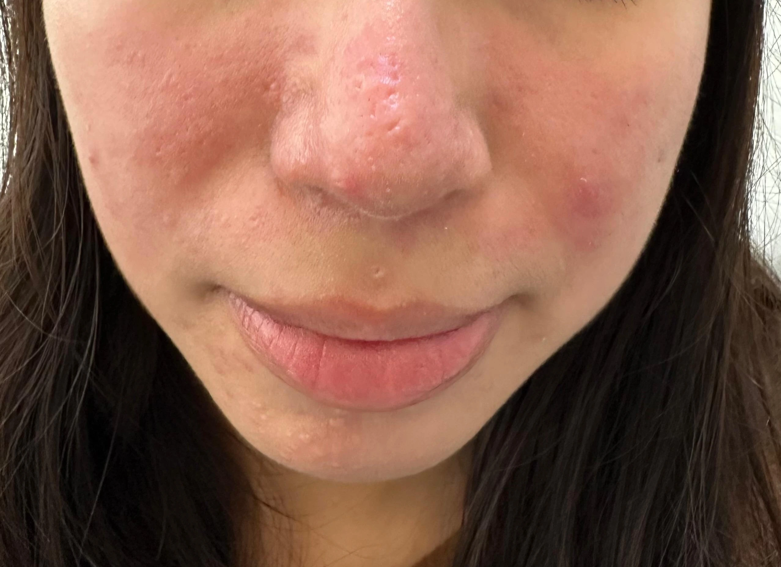 Tratamiento de Rosácea - Después